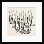 Disarticulation by Anonymous