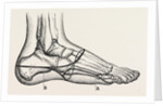 Disarticulation of the little toe by Anonymous