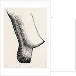 Syme's amputation by Anonymous