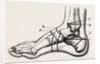Farabeuf's subastragaloid amputation by Anonymous