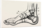Farabeuf's subastragaloid amputation by Anonymous