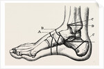 Farabeuf's subastragaloid amputation by Anonymous