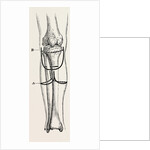 Amputation by Anonymous