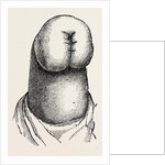 The stump by Anonymous