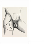 Disarticulation by Anonymous