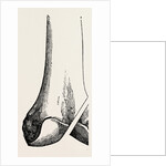 Ogston's operation by Anonymous