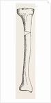 Diagram representing a curved tibia, with a wedge removed by Anonymous