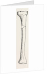 Diagram representing a curved tibia, with a wedge removed by Anonymous