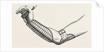 Ollieris wire splint for excision of the wrist by Anonymous