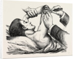Excision of the elbow, the clearing of the humerus by Anonymous
