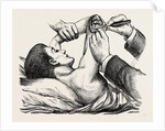 Excision of the elbow, the clearing of the humerus by Anonymous