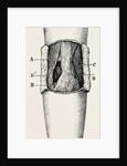 Right elbow after excision by Anonymous