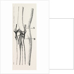 Excision by Anonymous