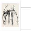 Excision by Anonymous