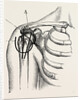 Excision of the shoulder by Anonymous
