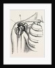 Excision of the shoulder by Anonymous
