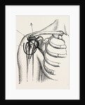 Excision of the shoulder by Anonymous