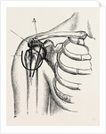 Excision of the shoulder by Anonymous