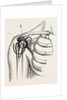 Excision of the shoulder by Anonymous