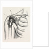 Excision of the shoulder by Anonymous