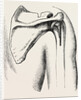 Excision of shoulder by Anonymous