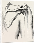 Excision of shoulder by Anonymous