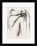 Excision of shoulder by Anonymous