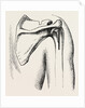 Excision of shoulder by Anonymous