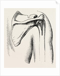 Excision of shoulder by Anonymous