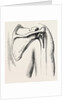Excision of shoulder by Anonymous