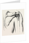 Excision of shoulder by Anonymous