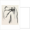 Excision of shoulder by Anonymous