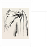 Excision of shoulder by Anonymous