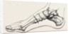 Excision of first metatarsal bone by Anonymous