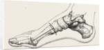 Excision of first metatarsal bone by Anonymous