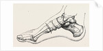 Excision of first metatarsal bone by Anonymous
