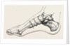 Excision of first metatarsal bone by Anonymous