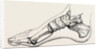Eicision of first metatarsal bone, flap by Anonymous