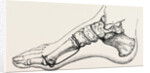 Eicision of first metatarsal bone, flap by Anonymous