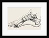 Eicision of first metatarsal bone, flap by Anonymous