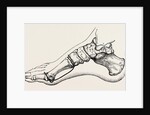 Eicision of first metatarsal bone, flap by Anonymous
