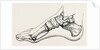 Eicision of first metatarsal bone, flap by Anonymous