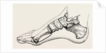 Eicision of first metatarsal bone, flap by Anonymous