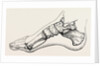 Eicision of first metatarsal bone, flap by Anonymous