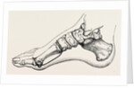 Eicision of first metatarsal bone, flap by Anonymous