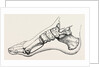 Eicision of first metatarsal bone, flap by Anonymous