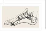 Eicision of first metatarsal bone, flap by Anonymous