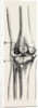 Excision of the operation the limb by Anonymous