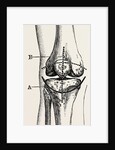 Excision of the operation the limb by Anonymous