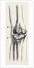 Excision of the operation the limb by Anonymous